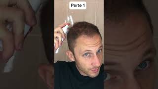 É isso que faço para crescer meu cabelo Como Aplicar Minoxidil para Calvicie Hereditaria Parte 1 [upl. by Ennairek80]