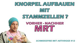 Stammzellen Knorpel aufbauen Stammzelltherapie Vorher  Nachher MRT Schmerzfrei mit Arthrose 12 [upl. by Tnaryb327]