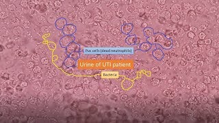 Urine of UTI patient under the Microscope [upl. by Tserrof]