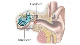 Meniere Disease [upl. by Onitselec820]