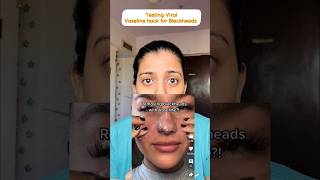 Testing Vaseline to remove Blackheads  Blackheads hack hack [upl. by Adnerak]