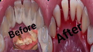 Tartar removed from teeth secret of teeth cleaning [upl. by Damahom]