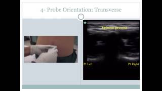 Ultrasound Guided Lumbar Puncture [upl. by Skipper]