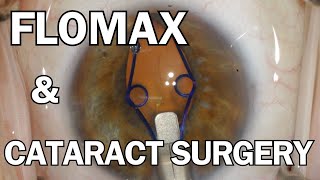 FLOMAX amp Cataract Surgery  My Approach [upl. by Nedaj]