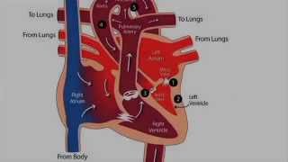 What is hypoplastic left heart syndrome HLHS [upl. by Asilanom]