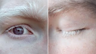 Why Eyelashes Become White and how to treat [upl. by Brade677]