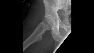 Radiographic PositioningProcedures involving the Pelvis and Hip [upl. by Boyes]