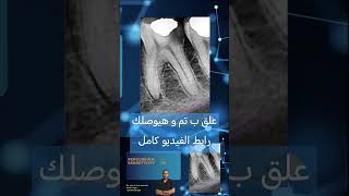 Clinical cases in Endodontics الكربولة endodontics dental [upl. by Sewoll]