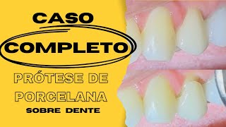 Prótese de porcelana sobre dente  caso completo [upl. by Atikram]