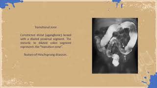 Meconium Ileus Review  Cases amp MCQs [upl. by Navinod]