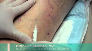 Sclerotherapy For Leg Veins  Mitchel P Goldman MD  San Diego [upl. by Rochelle]