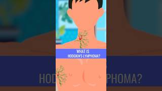 What is HODGKINS LYMPHOMA [upl. by Nitsirk]