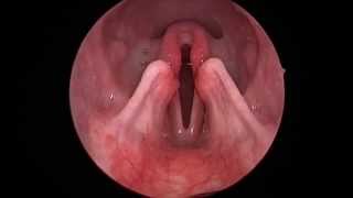 Dog Lar Par Laryngeal paralysis observed in sedated canine oral exam [upl. by Sylvia563]