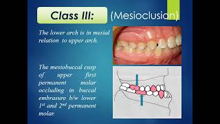 ortho 501 Classification of malocclusion [upl. by Anayt]