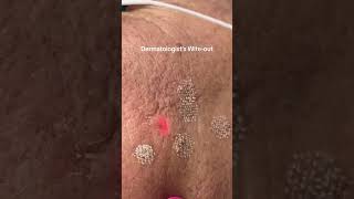 Sun Spot Removal shortvideo shorts laser [upl. by Savanna166]