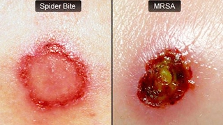 How To Cure A MRSA Infection Naturally  What Is MRSA Infection And Its Natural Treatment [upl. by Oinotna364]