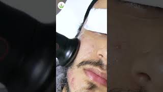 Acne Scar Removal Procedure for Flawless Skin at Care Well Medical Centre [upl. by Keavy]