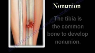 NONUNION OF FRACTURES CAUSES AND TREATMENT  Everything You Need To Know  Dr Nabil Ebraheim [upl. by Tatianna]