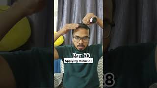 Day 28 Hair Regrowth journey Applying minoxidil bald minoxidil minoxidilresult hairloss [upl. by Assenahs]