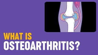 What is osteoarthritis [upl. by Hnil]