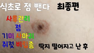 점빼고 난후쥐젖 비립종식초로점뺀다딱지떨어진후사후관리 [upl. by Ahcim]