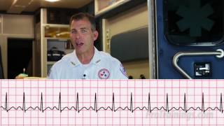 Premature Ventricular Contractions PVCs Animation [upl. by Klusek]