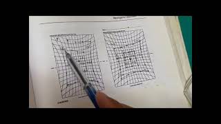 muscle sequelae  hess chart  incomitant squint  diplopia nerve palsy Orthotropics [upl. by Colver]