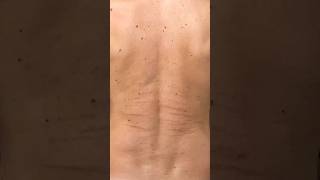 STRETCH MARKS  TREATMENT  STRIAE  SKIN CARE TIPS  HEALTHY SKIN  CLEAR SKIN  SKIN CARE viral [upl. by Jordans]