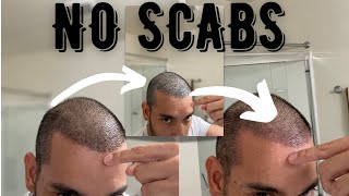 How To Remove Hair Transplant Scabs TUTORIAL [upl. by Faletti]