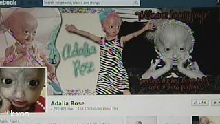 Adalia Rose Austinite social media star with rare genetic condition dies at 15 [upl. by Alisun]