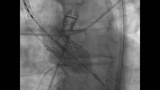 TAVR Implantation Aortogram under Fluoroscopic Guidance SAPIEN 3 [upl. by Rabaj]