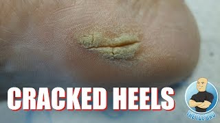 HOW TO GET RID OF CRACKED HEELS  FULL TREATMENT [upl. by Larimor]