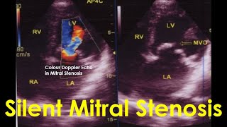 Silent Mitral Stenosis [upl. by Therese183]