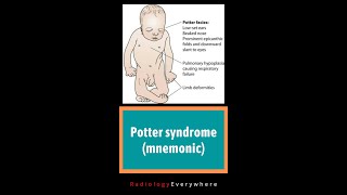 Potter syndrome  mnemonic POTTER  Radiology tutorials  BL renal agenesis  video 48 [upl. by Torras766]