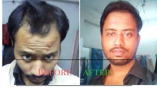 Hair loss before after using onion juice nail rubbing or balayam yoga and scalp exercise [upl. by Myrtie]