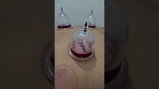 Cupping therapy shortsfeed viralshort viralvideos ytshorts [upl. by Anit]