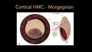 Lens  Part 2 Cataract  Pathophysiology amp Types [upl. by Ethelred297]