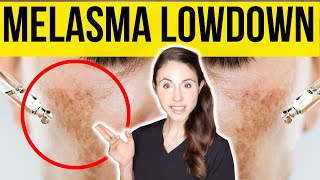 Get The Lowdown On Melasma From A Dermatologist [upl. by Nadnarb]