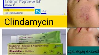 Clindamycin Malayalam review how to use Clinmiskin gel  മുഖകുരു മാറാൻ  clindac A gel Malayalam [upl. by Aundrea]