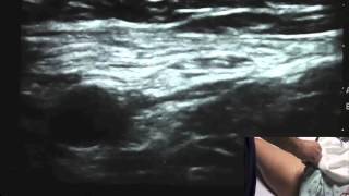 Ultrasound Guided Femoral Nerve Block  SSRAUSAcom [upl. by Patton957]