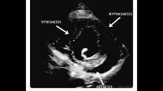 Hypokinesia Dyskinesia and Akinesia in a Single Echocardiography Frame [upl. by Arlin]