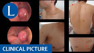 Neurofibromatosis type 1 and a gastrointestinal tumour [upl. by Arhaz]