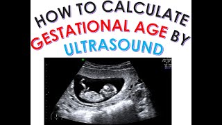 HOW TO CALCULATE GESTATIONAL AGE AND EDD DUE DATE BY ULTRASOUND DATING SCAN SECOND TRIMESTER SCAN [upl. by Sidalg]