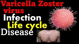 Varicella zoster virus pathogenesis  chickenpox virus [upl. by Euqinommod]