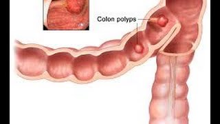 What is a Colon Polyp  Los Angeles Colonoscopy [upl. by Reddin]