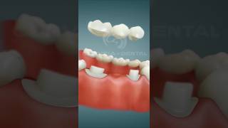 Use earphone Dental Bridge Porcelain Procedure after extraction satisfying [upl. by Bodkin]