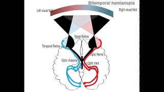 Lesion at the Optic chiasma and Bitemporal Heteronymous Hemianopia [upl. by Eelahc]