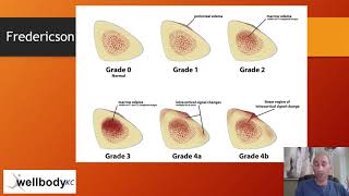 Shin Splints vs Stress fractures [upl. by Tekla657]