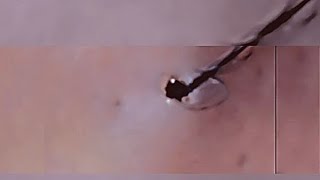 Removal of ingrown hair [upl. by Ainer]