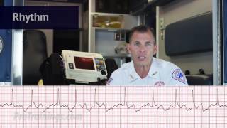 Atrial Fibrillation ECG Rhythm Interpretation [upl. by Deni619]